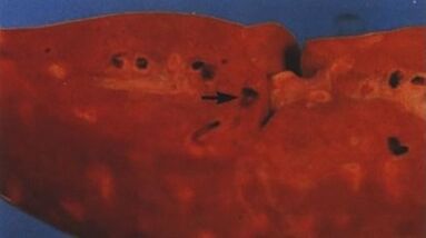 какие паразиты могут жить в печени человека